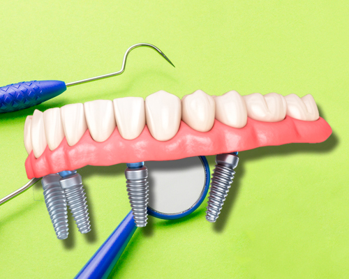 Onze dentes postiços, vistos na lateral, em cima de 4 parafusos cônicos.